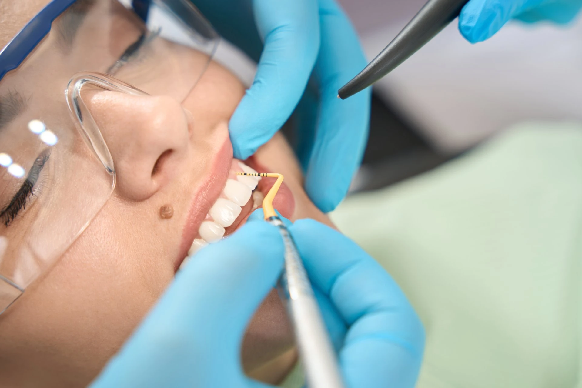 What is Full Mouth Restoration?