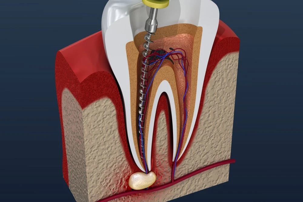What is a Root Canal?