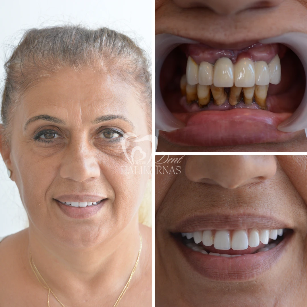 Discover Our Patients<br>Smile Transformations