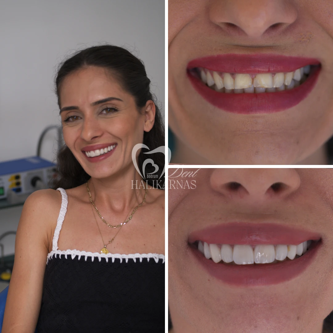 Discover Our Patients<br>Smile Transformations