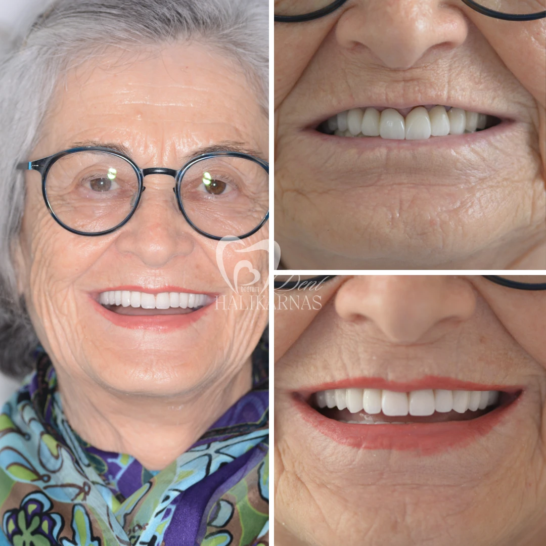 Discover Our Patients<br>Smile Transformations